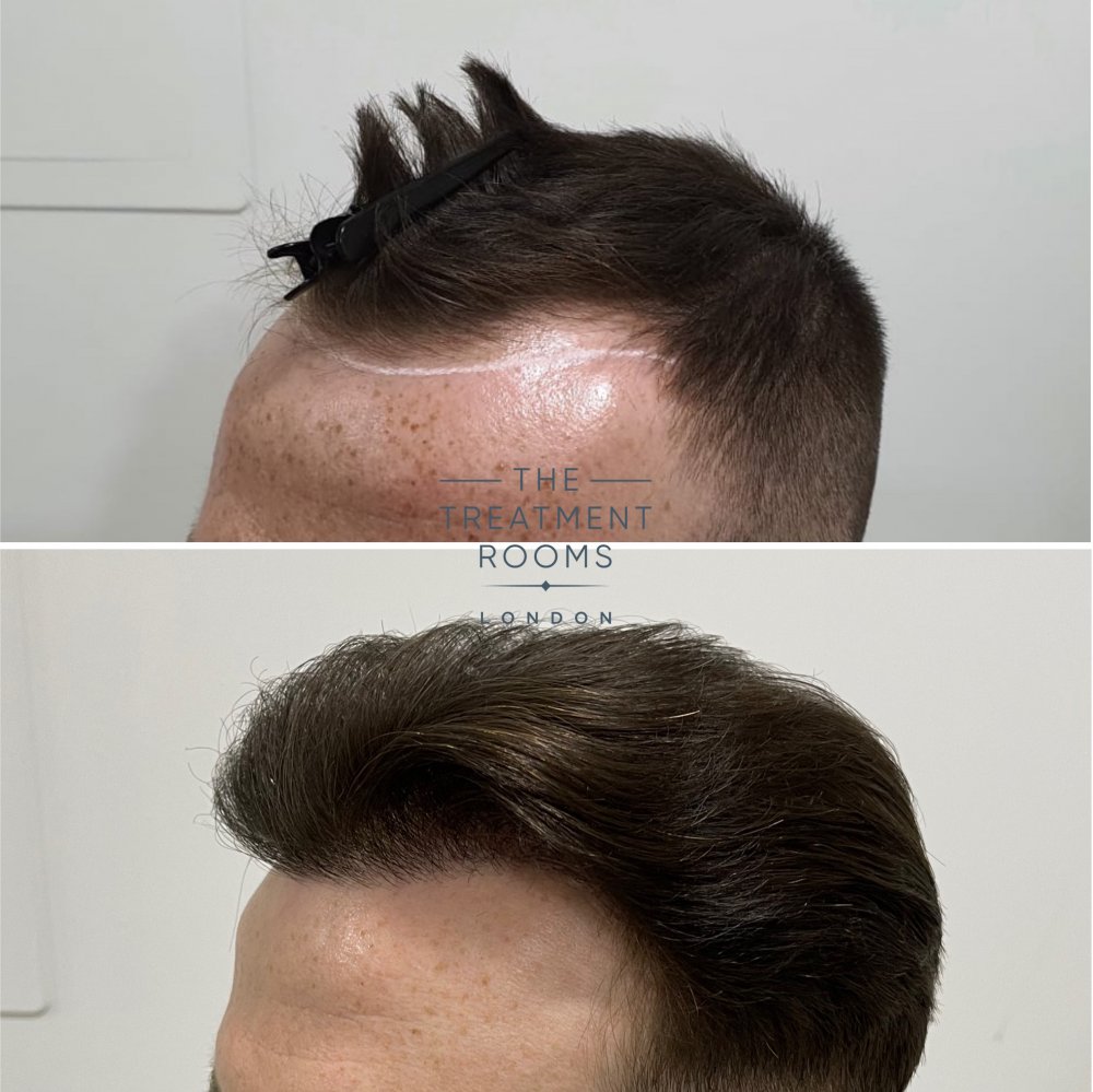 Hair transplant Treatment Rooms London.jpg