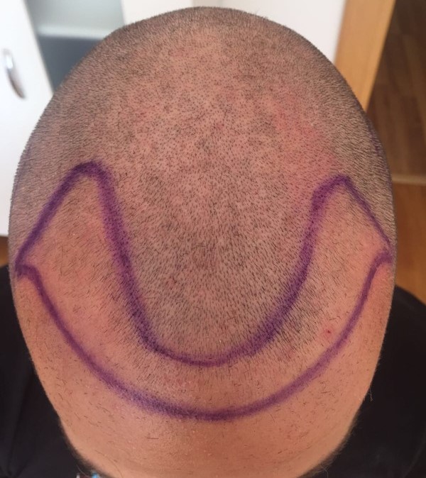 Hair transplant Turkey Dr Bicer 2.jpg