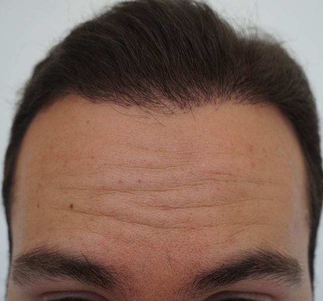 Hair transplant Turkey Dr Bicer 3.png