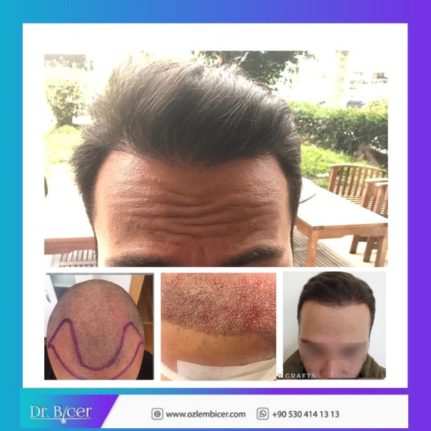 Hair transplant Turkey Dr Bicer 4.jpg