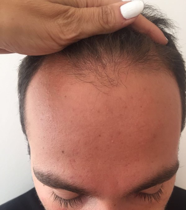 Hair transplant Turkey Dr Bicer.jpg