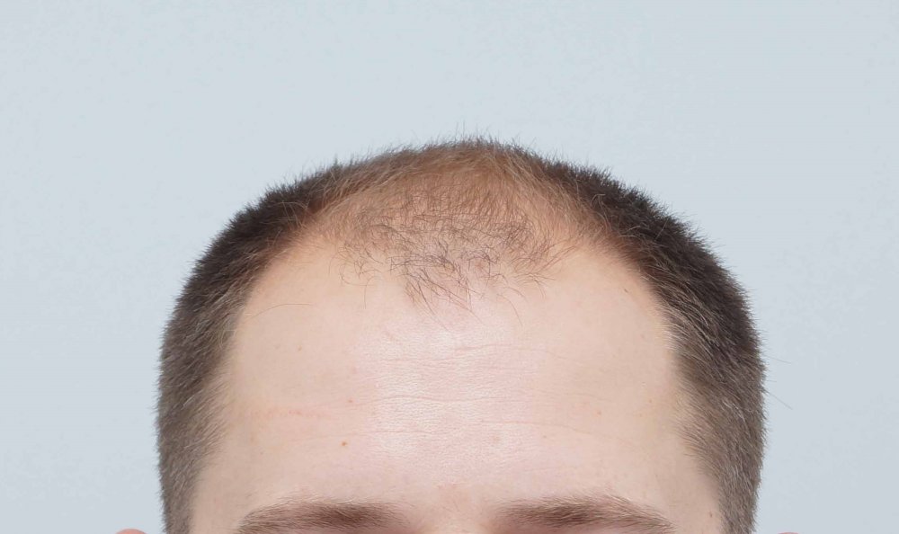 Hair Transplant with Dr Bessam Farjo1.jpg