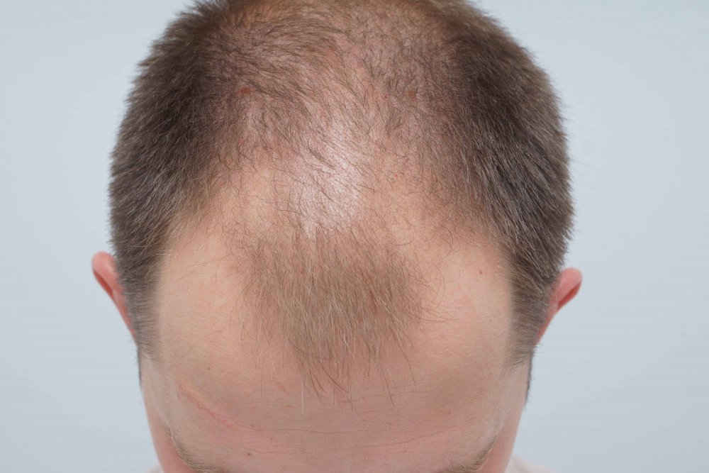 Hair Transplant with Dr Bessam Farjo2.jpg