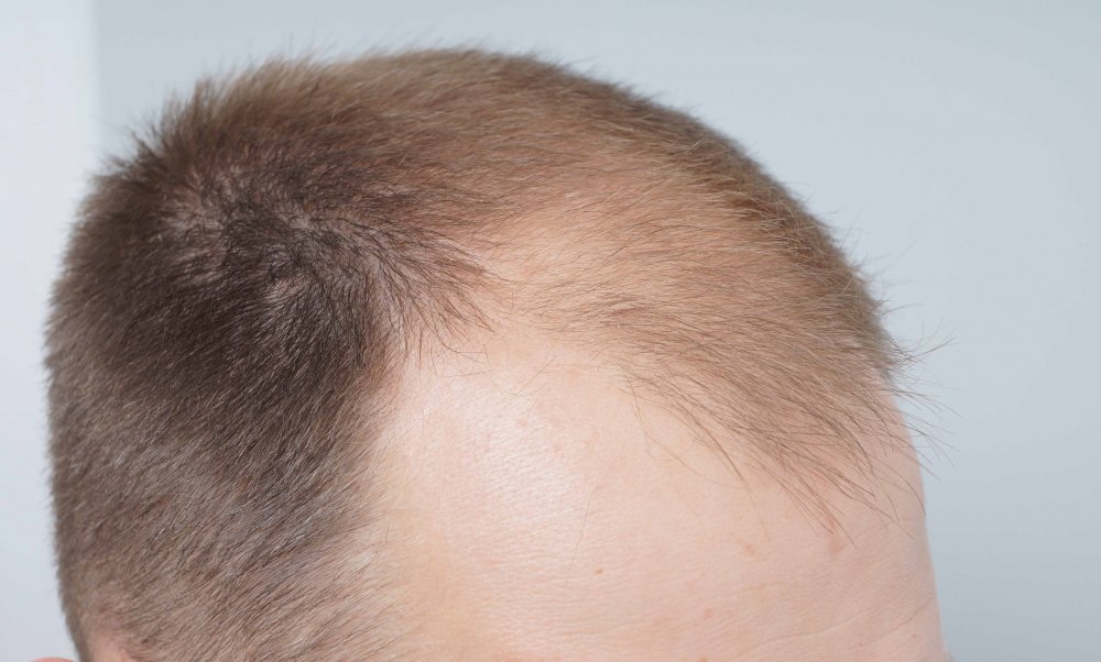Hair Transplant with Dr Bessam Farjo3.jpg