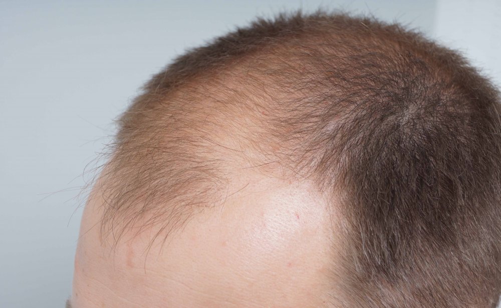 Hair Transplant with Dr Bessam Farjo4.jpg