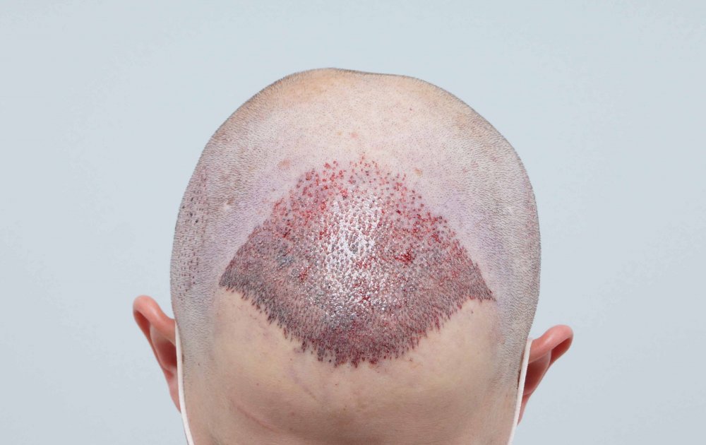 Hair Transplant with Dr Bessam Farjo5.jpg