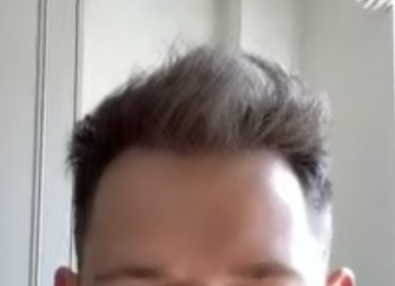 Hair Transplant with Dr Bessam Farjo6.jpg