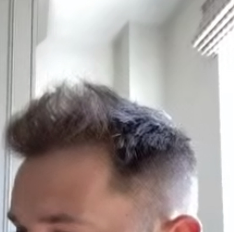 Hair Transplant with Dr Bessam Farjo7.jpg