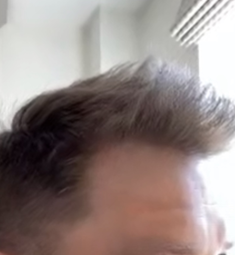 Hair Transplant with Dr Bessam Farjo8.jpg