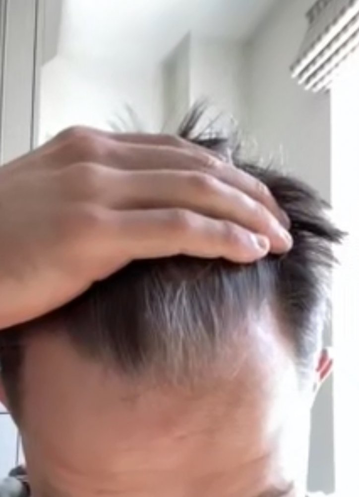 Hair Transplant with Dr Bessam Farjo9.jpg