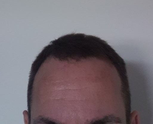 Hair transplant with finer hair.jpg