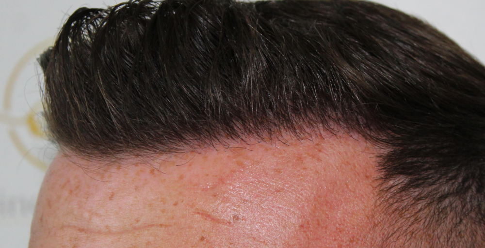 hairline-close-up-dr-bonaros.png