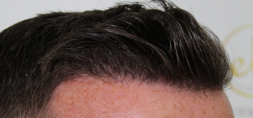 hairline-close-up.png