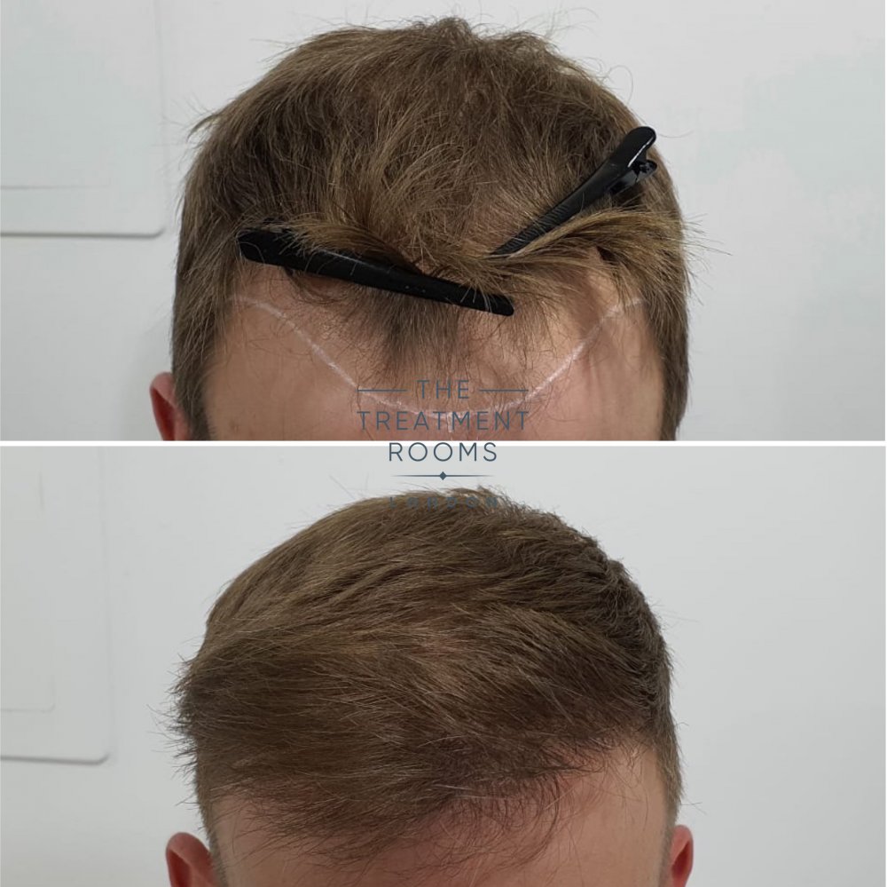 Hairline closeup before and after FUE hair transplant.jpg