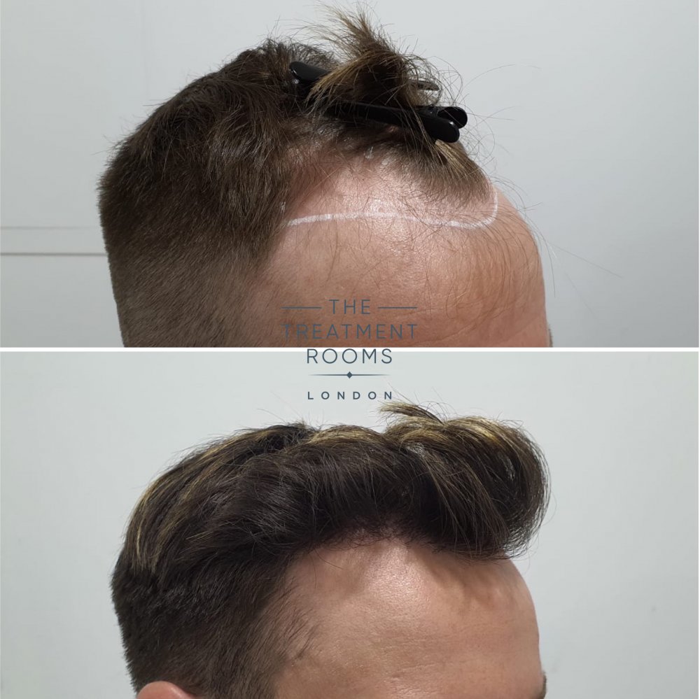 hairline dhi hair transplant before and after 1724 grafts.jpg