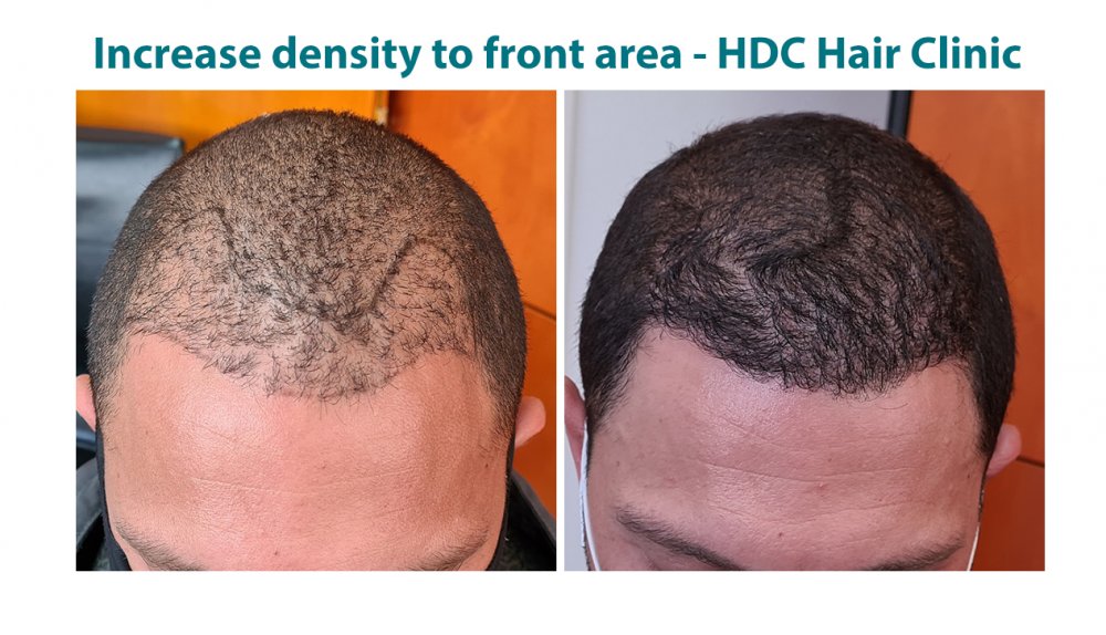 Hairline Enhancment Poestos HT 28-01-21 for 1872 grafts  Set 1.jpg