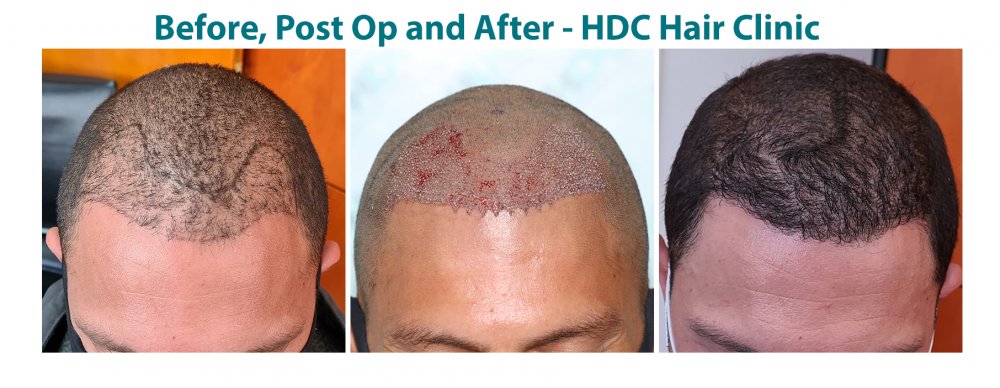 Hairline Enhancment Poestos HT 28-01-21 for 1872 grafts  Set 2.jpg