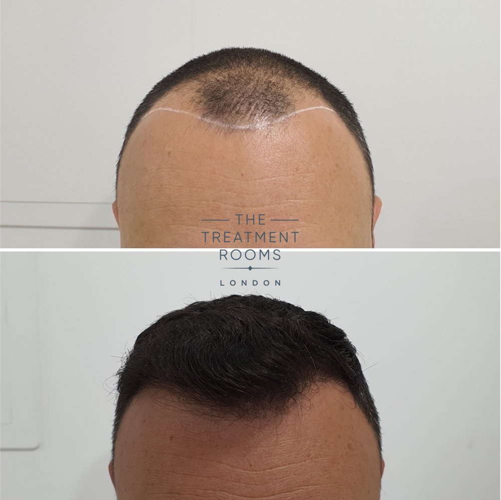 Hairline FUE hair transplant before and after 1498 grafts.jpg