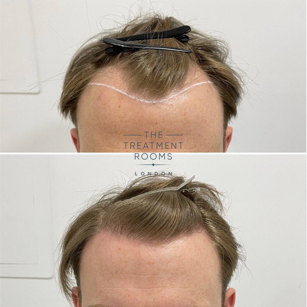hairline fue hair transplant before and after 1700 grafts.jpg
