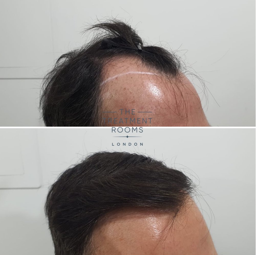 hairline FUE hair transplant before and after 1800 grafts.jpg