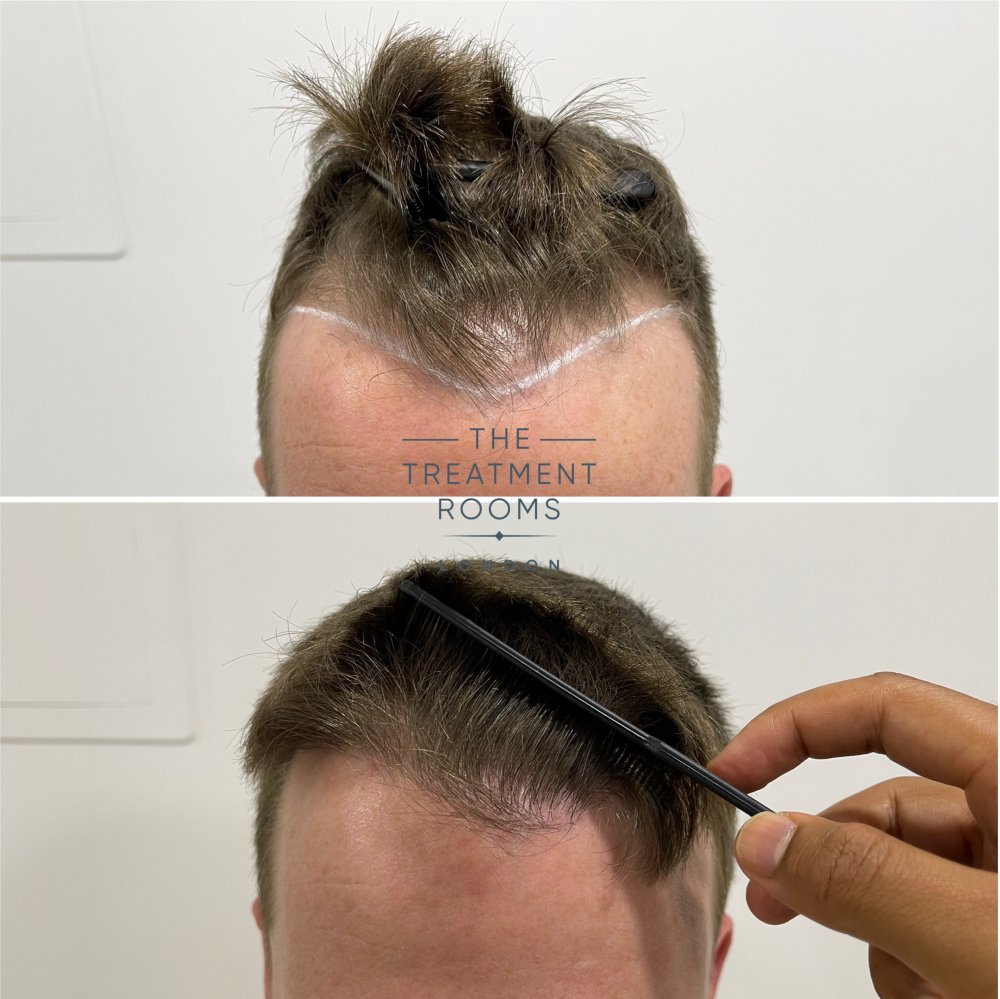 hairline fue hair transplant before and after closeup.jpg