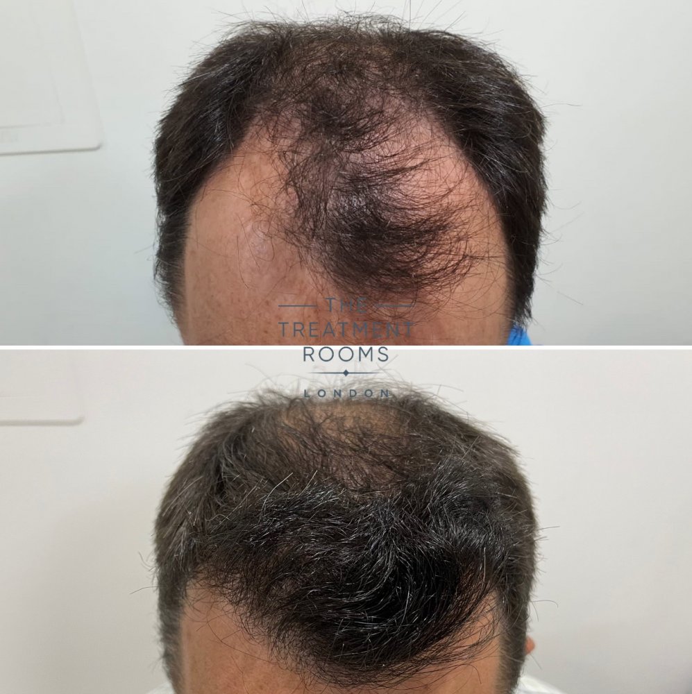 Hairline FUE hair transplant before and after.jpg