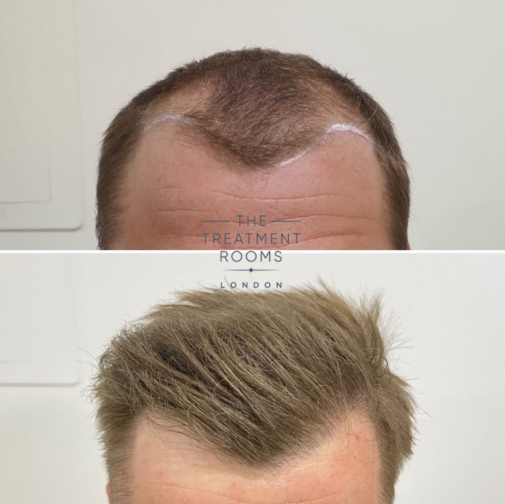 Hairline FUE hair transplant result.jpg
