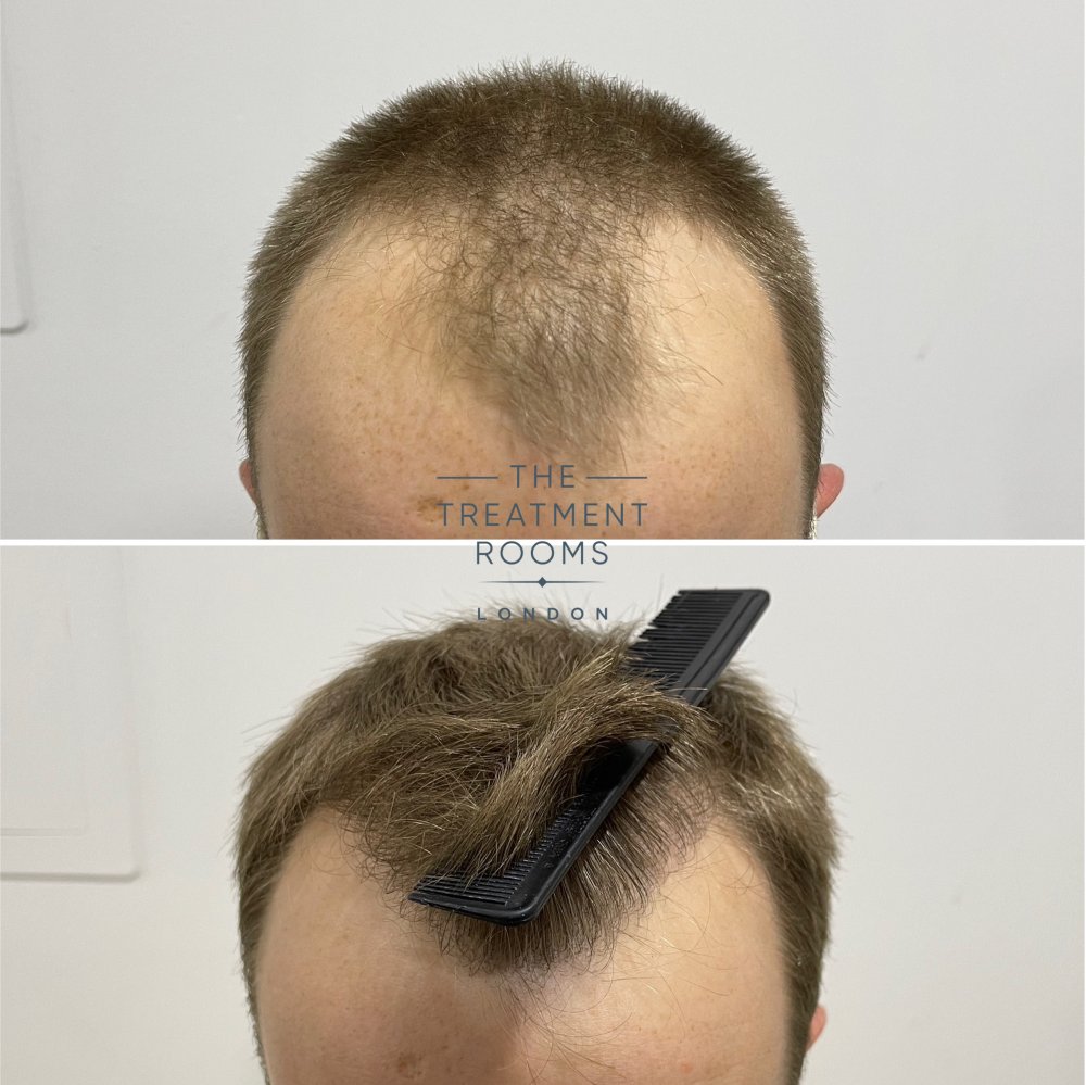 hairline fue transplant 1756 grafts before and after.jpg