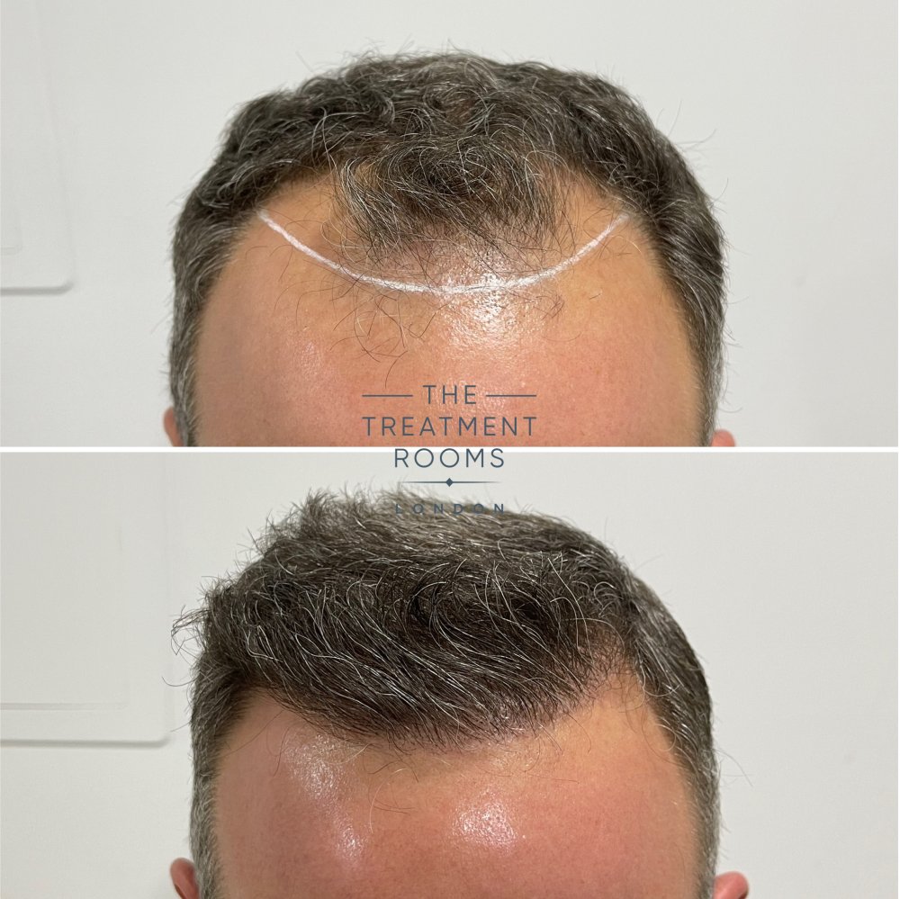 hairline fue transplant 1788 grafts before and after.jpg