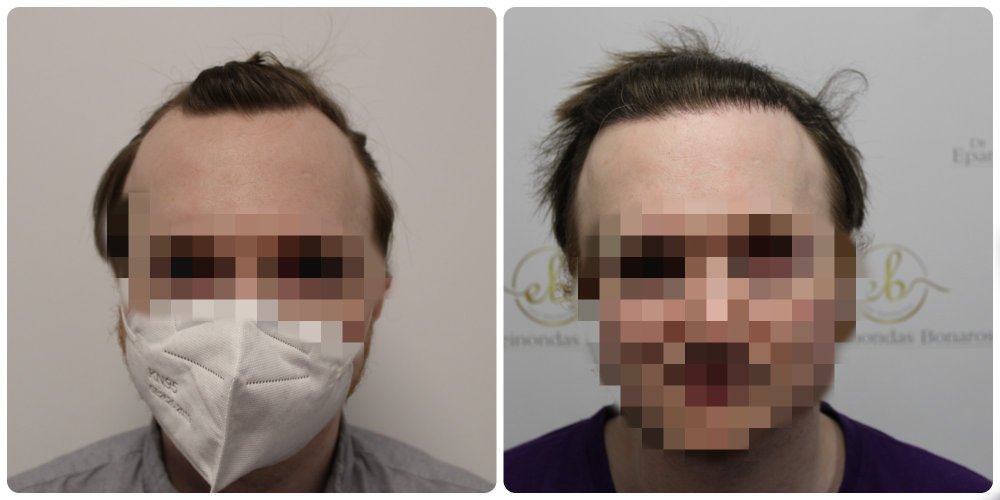 hairline-hair-transpant-glasgow-dr-bonaros.jpg