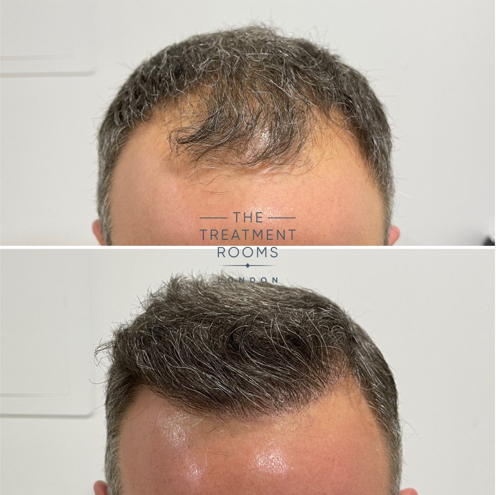 hairline hair transplant 1788 grafts before and after.jpg
