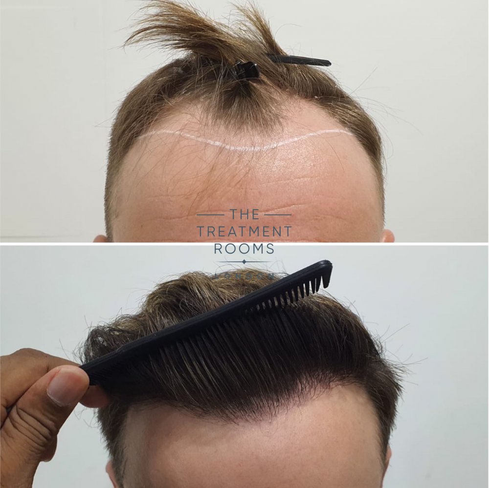 hairline hair transplant before and after 1724 grafts.jpg
