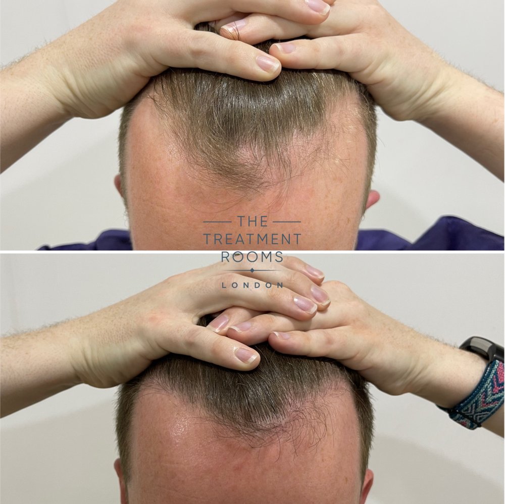 hairline hair transplant before and after closeup.jpg