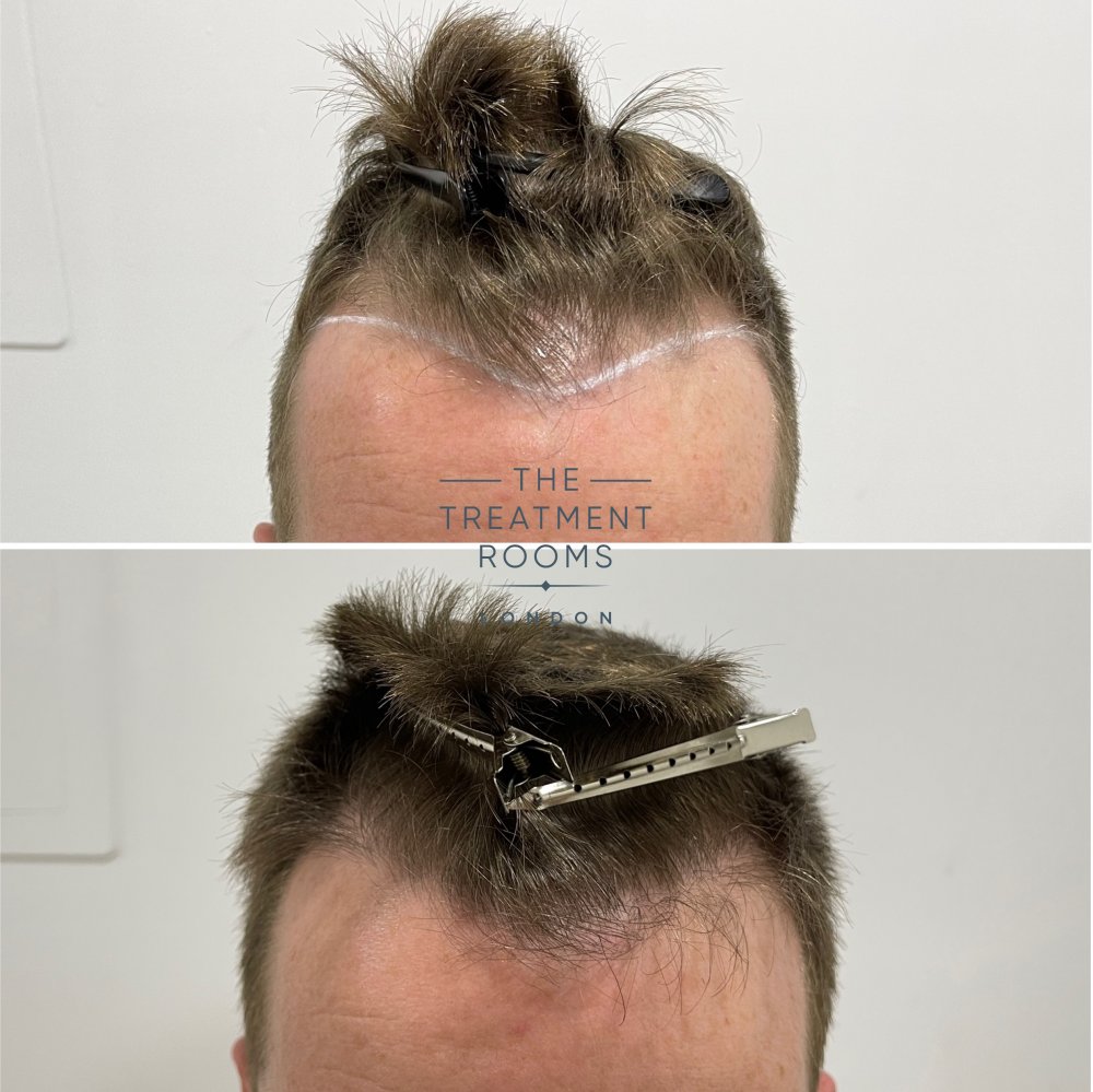 hairline hair transplant before and after.jpg