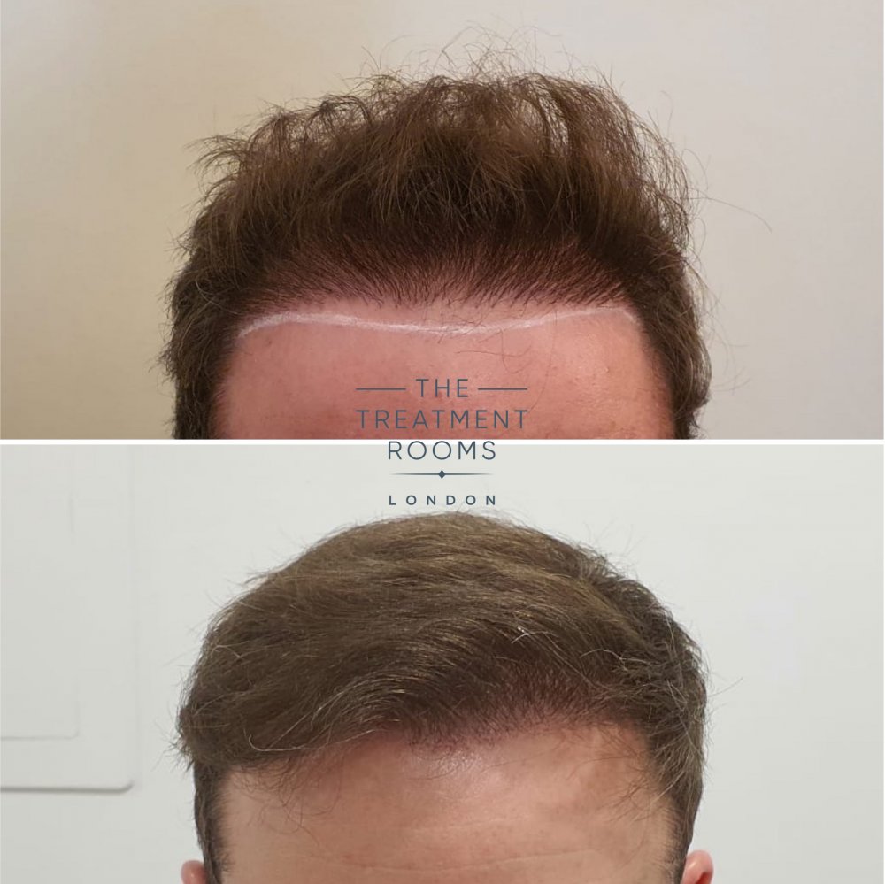 Hairline hair transplant repair.jpg
