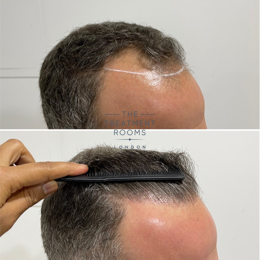 hairline hair transplant result 1788 grafts result.jpg