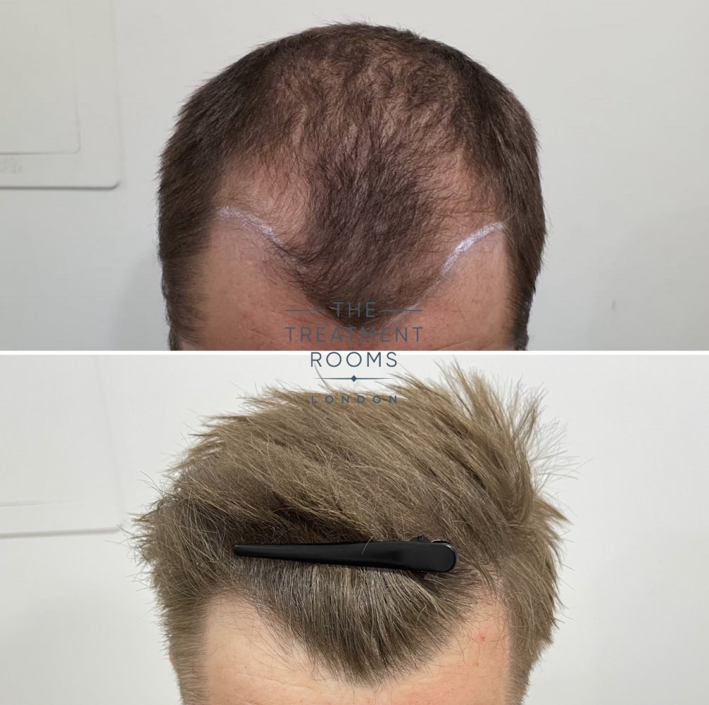 Hairline hair transplant result closeup.jpg
