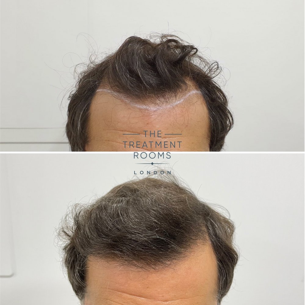 hairline hair transplant result.jpg