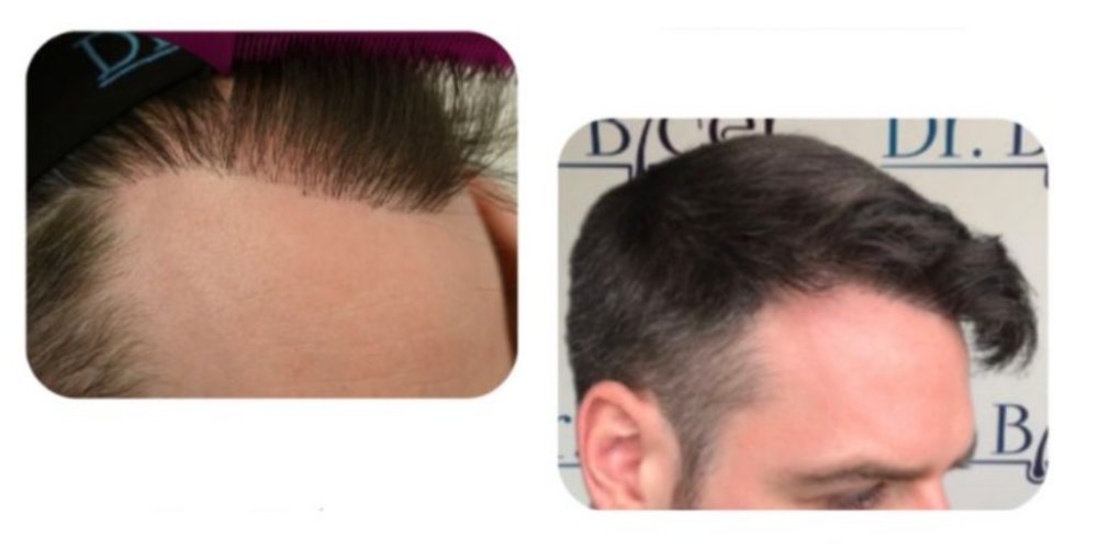hairline.repair.jpg