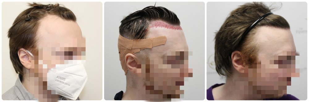 hairline-results-after-fue-scotland.jpg