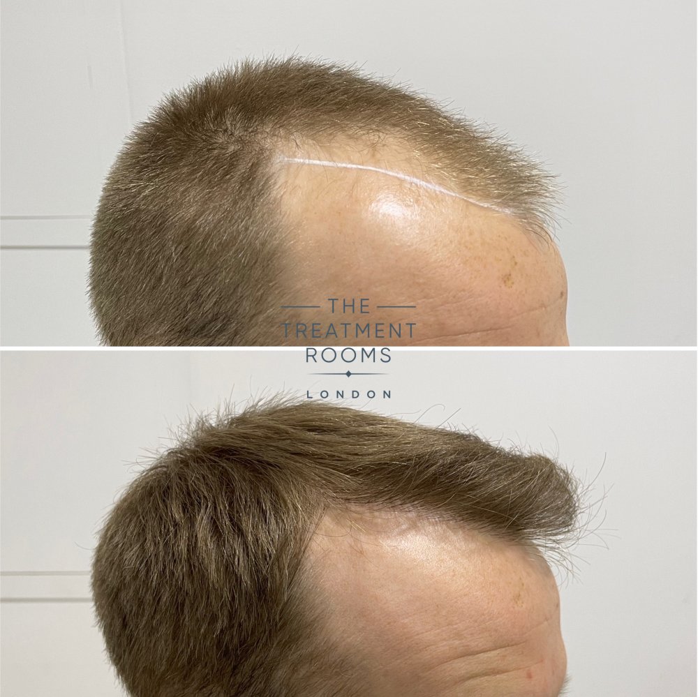 hairline transplant 1756 grafts before and after.jpg