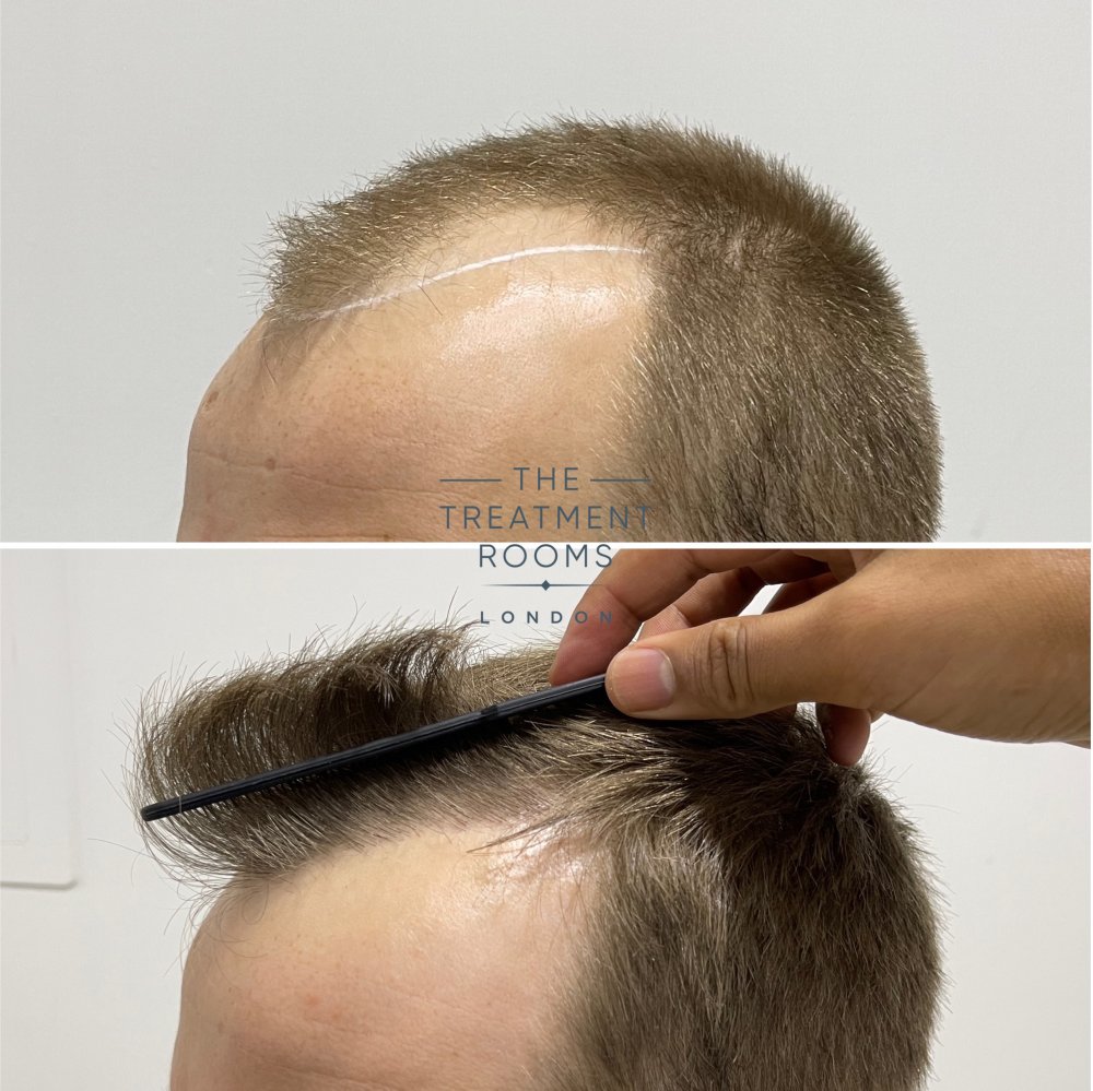 hairline transplant 1756 grafts result.jpg
