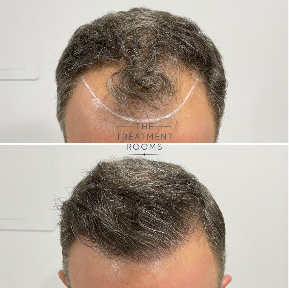 hairline transplant 1788 grafts before and after.jpg