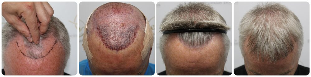 hairline-transplant-dr-bonaros.jpg