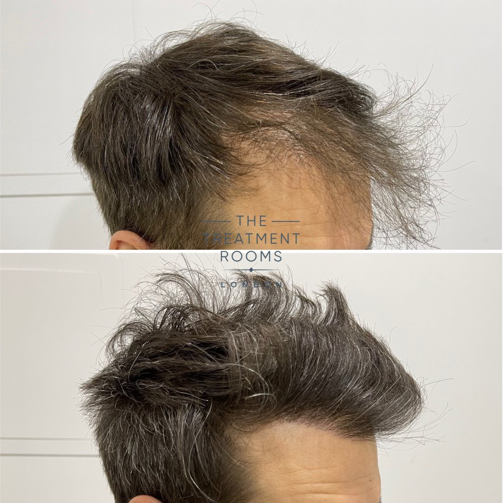 Hairline transplant repair result.jpg