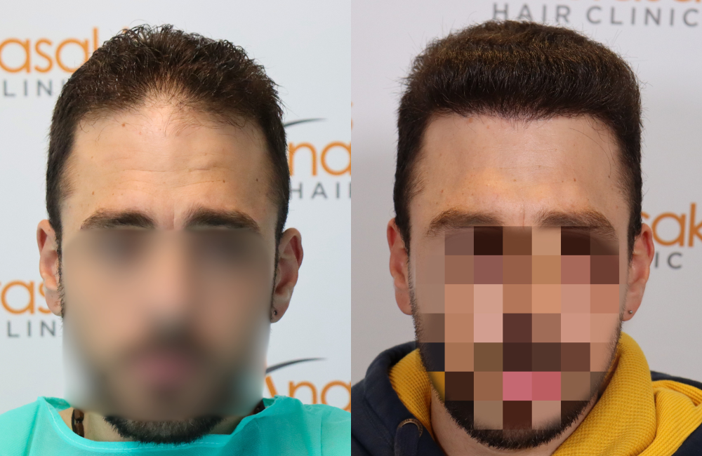 hairloss experiences photo collage (1).png