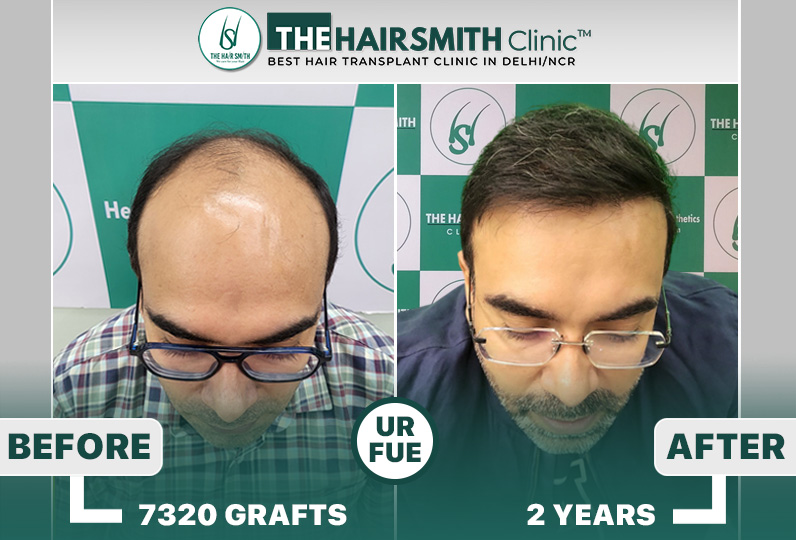 Hairsmith Hair Transplant Results #HairTransplant #HairTransplantResults.jpg