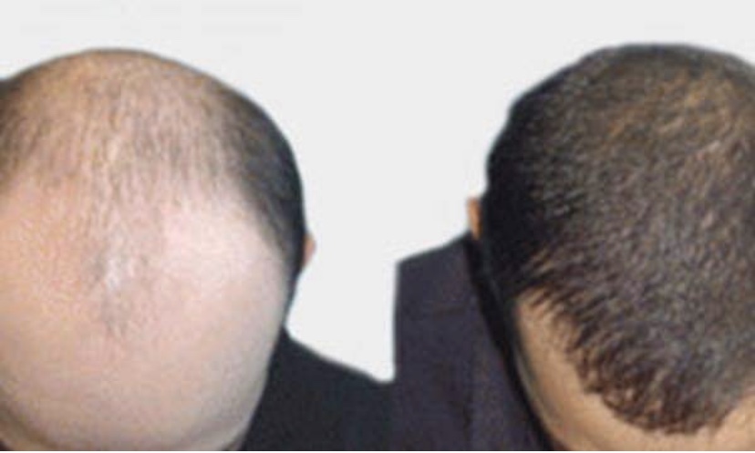 Harley st healthcare stolen images hair transplant.jpeg