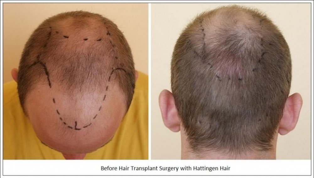 Hattingen Hair Hair Transplant 1.jpg