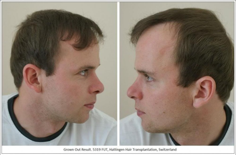 Hattingen Hair Hair Transplant 5.jpg